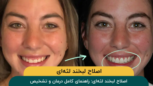 اصلاح-لبخند-لثه‌-ای